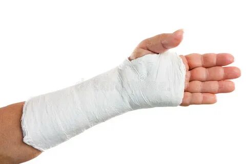 Broken Arm with Green Cast on White Background Stock Image -
