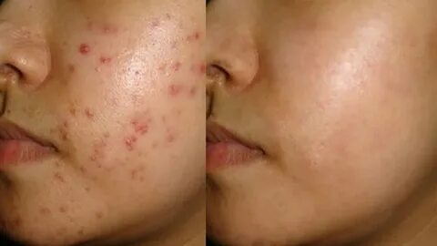 How To Remove Pimples Marks Naturally At Home - ReciBeauty