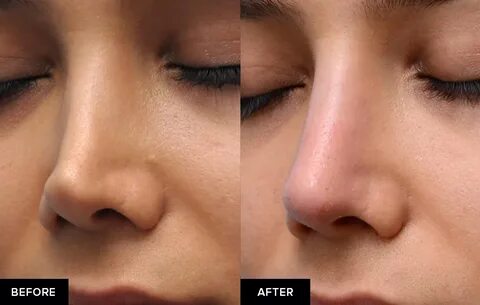 Non Surgical Revision Rhinoplasty in San Francisco Dr. David