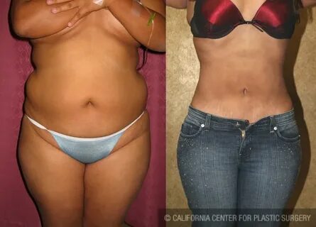 Patient #5509 Body Contouring Before and After Photos Beverl