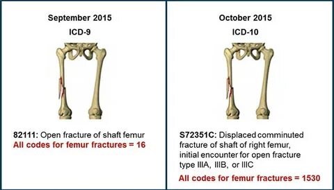 icd 10 code for left femur fracture #99DEGREE