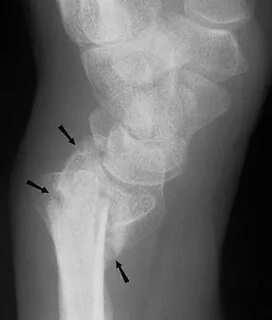 Distal Radius Fractures - Trauma - Orthobullets
