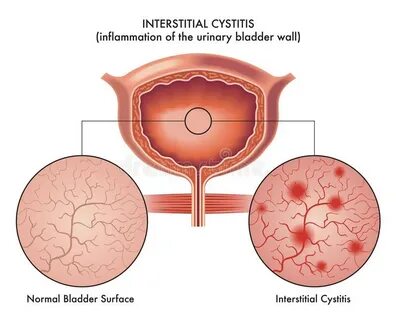 Interstitial Cystitis Icon. Trendy Modern Flat Linear Vector