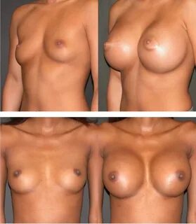 Nude breast implants.