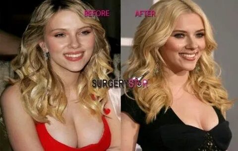 Scarlett Johansson Breast Reduction