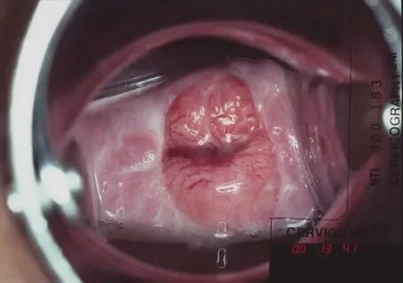 AIDED VISUAL INSPECTION OF THE CERVIX - End Cervical Cancer 