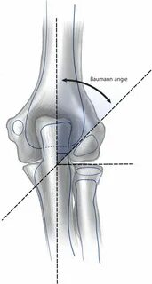 Supracondylar Fracture - Pediatric - Pediatrics - Orthobulle