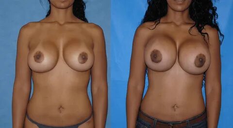 Nude breast implants.