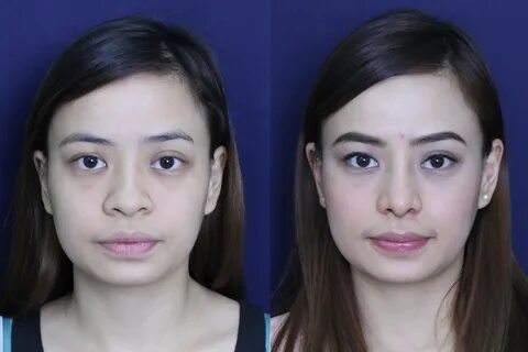 Filipino Non Surgical Nose Job - Non-Surgical Nose Job Case 
