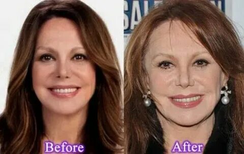 Marlo Thomas Before And After Plastic Surgery in 2020 Marlo 