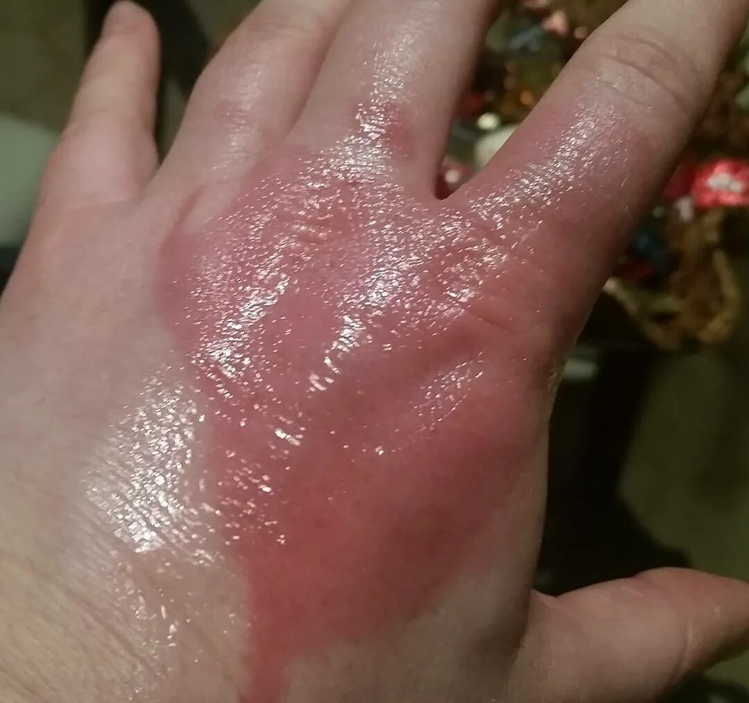 Burnt my hand with steam фото 85