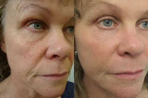 Eyelid Surgery Before And After Photos By Dr Lanzer
