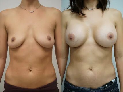 Plastic surgery porn pics