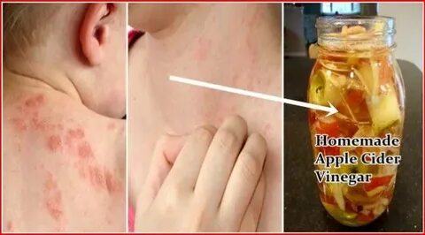 This Is How To Use Apple Cider Vinegar for Treating Eczema H