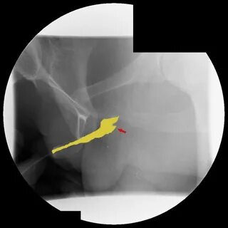 Ftm bottom surgery pictures