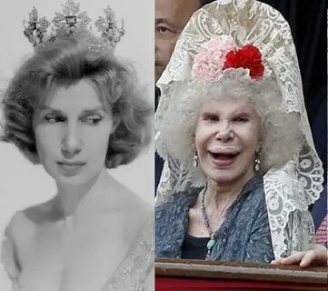 Did the Duchess of Alba Overdo Plastic Surgery?