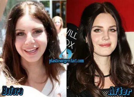 Lana Del Rey Before And After Plastic Surgery - Best Images 