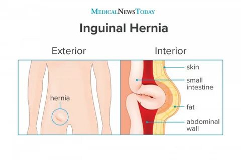 Diagram Of Groin Area - Inguinal Hernia