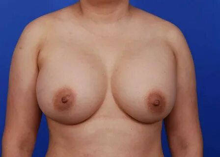 Patient 19501 - Breast Augmentation Before And After Photos