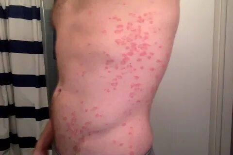 Guttate Psoriasis How Long Does It Last