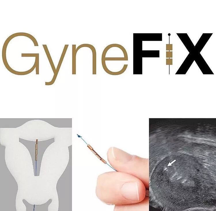 Instagram இல் 𝒹 𝓇.𝓂 𝑒 𝓁 𝓉 𝑒 𝓂 𝑒 𝓇 𝓀 𝓂 𝑒 𝓃: "#gynefix Ned...