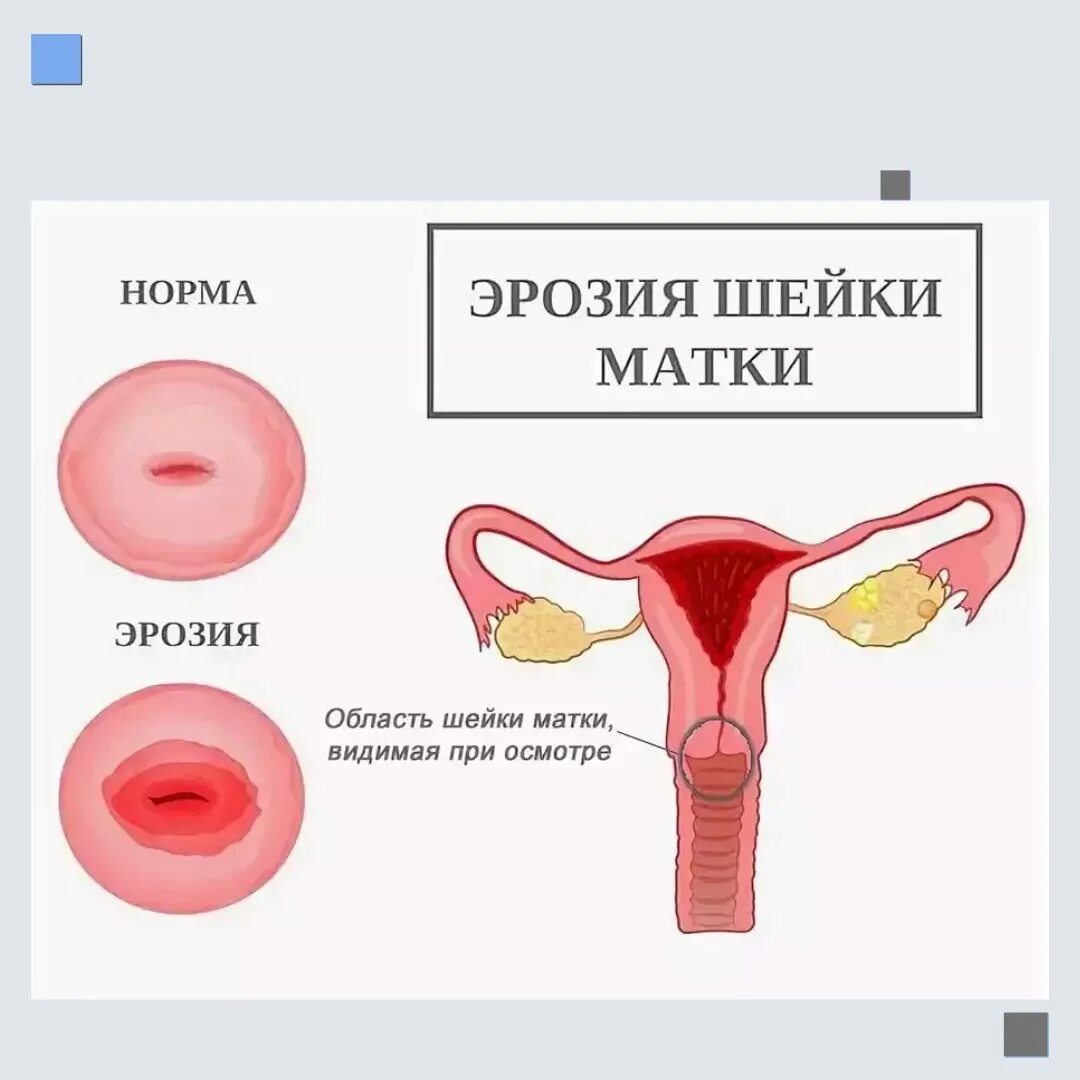 несовместимость спермы и шейки матки фото 81