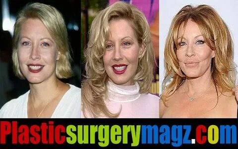 Linda Kozlowski Plastic Surgery Before and After Plastic Sur