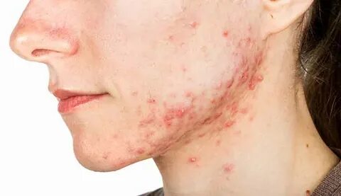 All You Need To Know About Ugly Cystic Acne