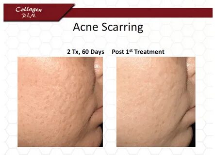 MicroNeedling and PRP Fairfield County Laser Skincare Specia