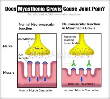 Remdesivir In Myasthaenia Gravis / Myasthenia Gravis - Causes And Symptoms - Doc