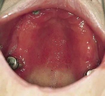 Заболевания слизистой оболочки полости рта - Курсовые, контр