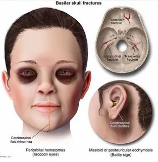 Basilar Skull Fracture: - Ophthalmology-Notes And Synopses Facebook