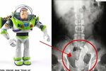 Patient has Buzz Lightyear doll stuck up rear, Health News -