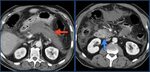 Lung Cancer Ct Scan With Contrast