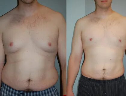 Male Breast Reduction (Gynecomastia) in Tijuana VIDA.