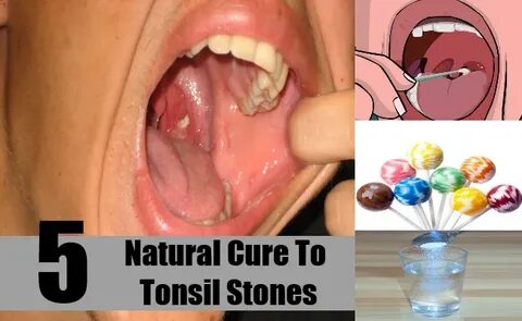 How To Get Rid Of Tonsil Stones Naturally