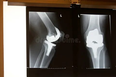 An Xray of a Knee with a Doctor`s Hand Stock Image - Image o