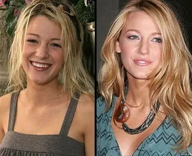 Blake Lively nose job Nose job, Celebrity plastic surgery, B