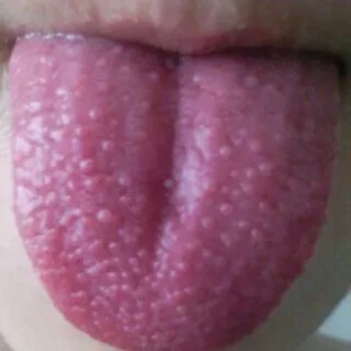 Bläschen auf der Zunge Med-koM