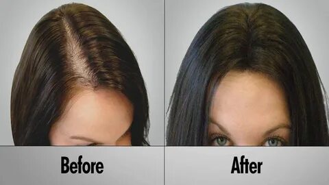 Prevent Hair Loss - How to Prevent Hair Loss Naturally Thick