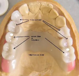 Teilprothese aus Acetat Praxis für ganzheitliche Zahnmedizin