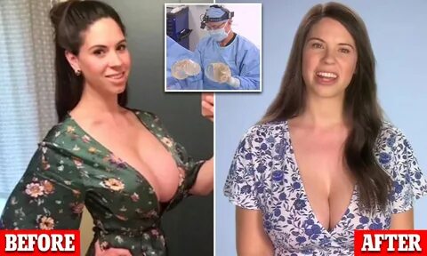 Big Boobs After Breast Surgery 18.