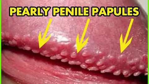 Home Remedies for Pearly Penile Papules - YouTube