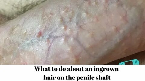 What to do about an ingrown hair on the penile shaft - YouTu