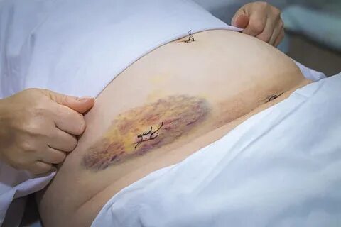Appendix Scar - Сток картинки - iStock