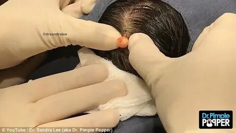 Dr Pimple Popper squeezes puss-filled cyst the size of a MAR