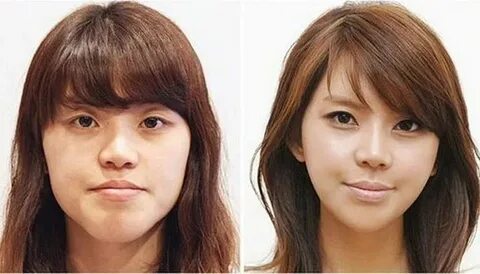 South Korea plastic surgery before and after photos Before a