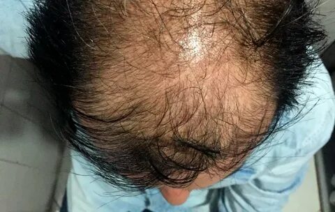Alopecia difusa - Sin Alopecia