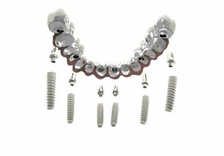 Full Arch Dental Implants - Carrollton, OH - Dover, OH - Min