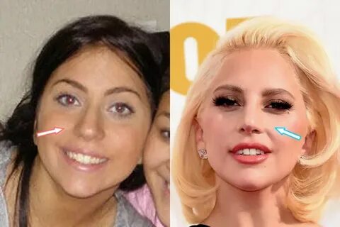 Does Lady Gaga Have Plastic Surgery? (Before & After 2018)